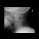 Skull fissure: X-ray - Plain radiograph